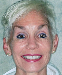 A woman smiling after her smile makeover