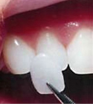 A single porcelain veneer being placed on a tooth