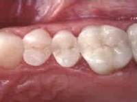 white-fillings-after