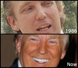 Donald Trump Porcelain Veneers