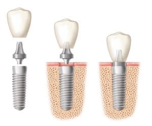 An illustration of three dental implants at various stages of crown placement