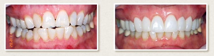 Two images of a smile. Left image: poorly done crowns. Right image: beautiful crowns fixed by Dr. Rothwell.