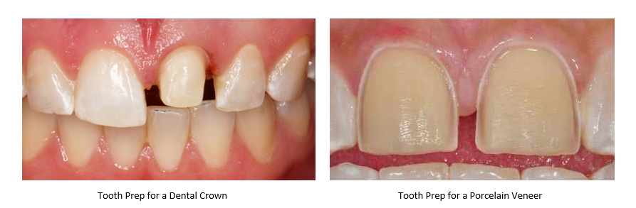 Difference between tooth prep fro a crown and a veneer
