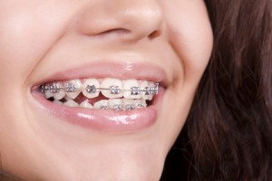 close up of  the smile of a girl wearing braces