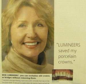 New Lumineers over old cosmetic work advertisement