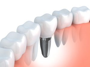 illustration of dental implant next to natural teeth