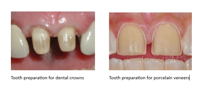 Side by Side tooth prep comparison