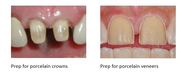 Side by side comparison of a dental crown tooth prep versus a porcelain veneer prep