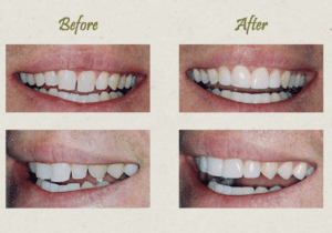 before and after dental bonding