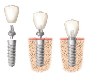 Dental implant in three stages